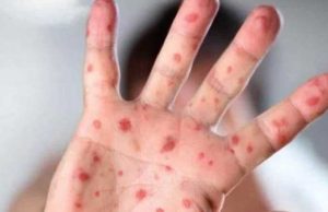 Aparecerán más casos de la viruela del mono: OMS