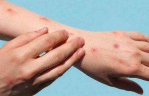 Viruela símica, presente en estados cercanos a Chiapas