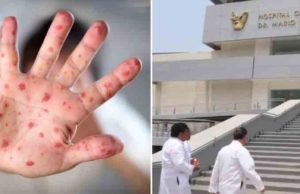 Viruela del mono es de baja letalidad y “diferente al COVID”, explicó Hugo López-Gatell