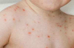 Gripe del tomate: el nuevo virus que ha aparecido