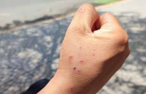 Chiapas confirma primer caso de viruela del mono