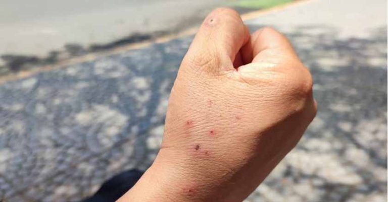 Chiapas confirma primer caso de viruela del mono