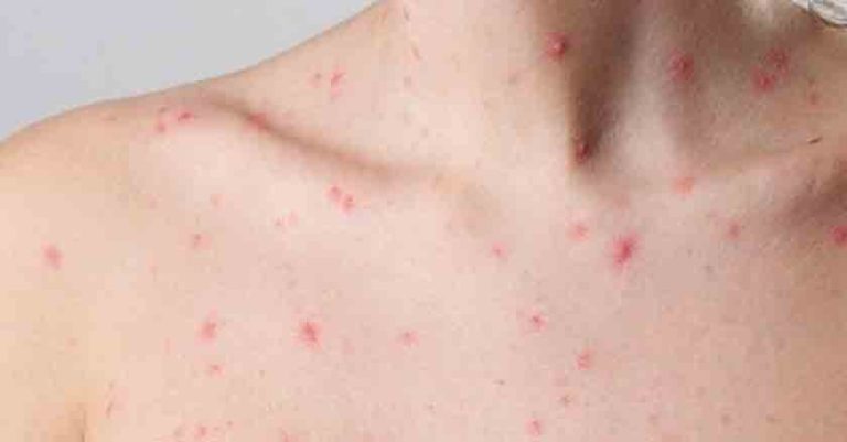 Chiapas registra tres nuevos casos de viruela de mono; acumula 20 pacientes