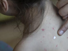 Salud reporta 30% menos casos activos de sarampión y aplicación de 13.3 millones de vacunas